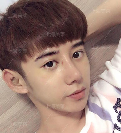 李?？?上海美萊自體軟骨隆鼻