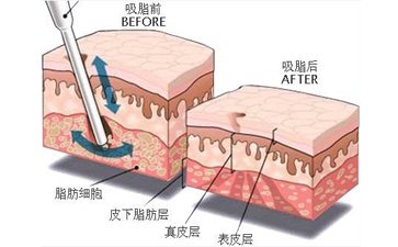 廣州哪家機構(gòu)吸脂減肥比較好