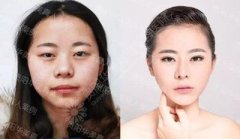 貴陽(yáng)美容瘦臉針需要多少錢一針