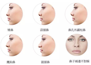 昆明美萊假體隆鼻費用多少