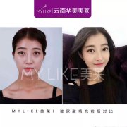 昆明打玻尿酸哪家好，打玻尿酸副作用有哪些？