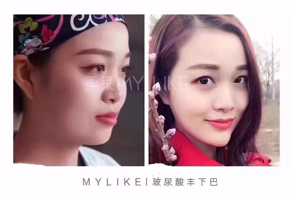 大中小分子玻尿酸有什么區(qū)別，法令紋又是用的什么