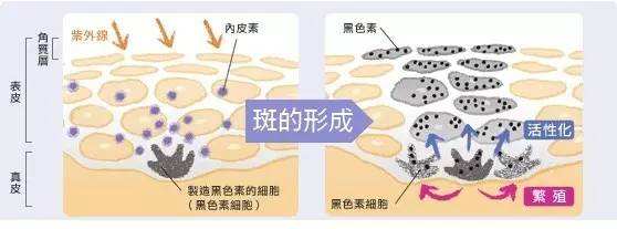 重慶激光去雀斑缺點有哪些
