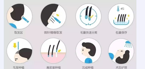 <a href='/cs/' target='_blank'><u>長沙美萊</u></a>教您怎樣拒絕禿頭——發(fā)際線拯救指南