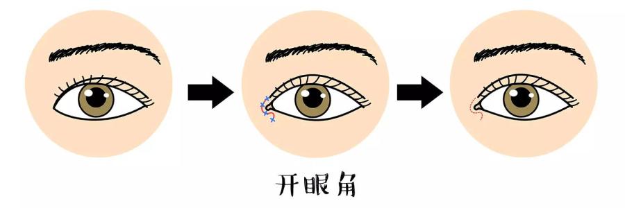 天津做開(kāi)眼角失敗了怎么辦