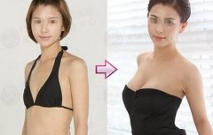 昆明假體隆胸的效果能保持多久？