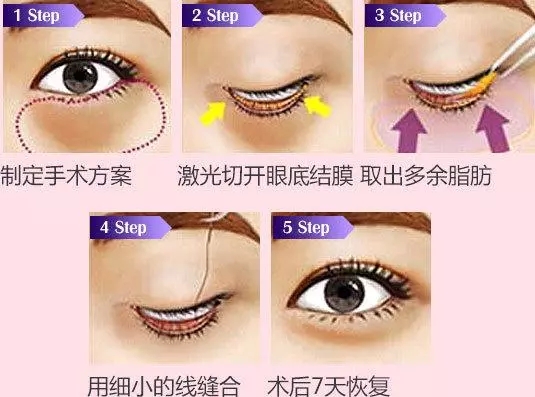 <a href='/sy/' target='_blank'><u>沈陽美萊</u></a>講解眼袋到底有多嚇人，你敢看嗎？