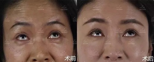 2018年過得很開心的你，皺紋有沒有增多？