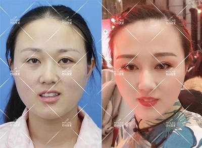 有些眼睛雙眼皮拯救不了，就來<a href='/suz/' target='_blank'><u>蘇州美萊</u></a>做眼綜合手術(shù)！