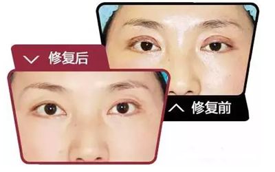 佛山什么時候做雙眼皮修復(fù)手術(shù)效果會比較好呢