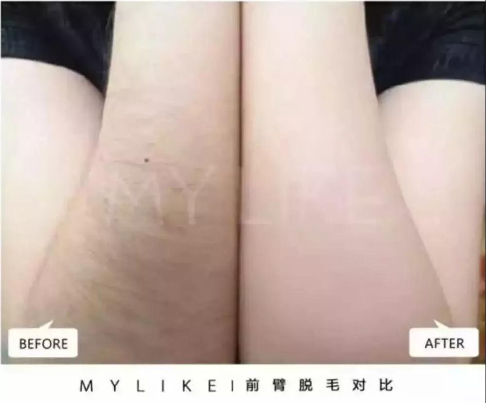 激光手臂脫毛術(shù)后會(huì)留下疤痕嗎