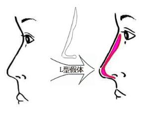 深圳假體隆鼻失敗修復多少錢？