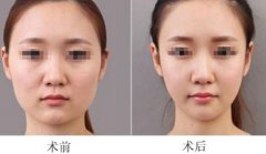 重慶面部吸脂能快速瘦臉嗎？
