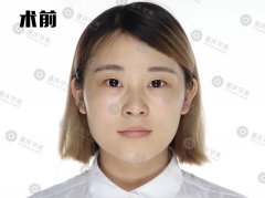 重慶華美雙眼皮大挑戰(zhàn)，術(shù)后半個(gè)月到底能不能被發(fā)現(xiàn)是割的？