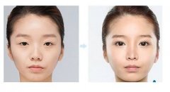天津做上瞼下垂矯正的價(jià)格是多少？