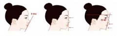 重慶做開(kāi)眼角之后不能吃哪些東西？