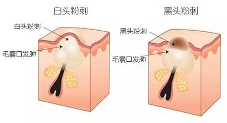 BYE-BYE草莓鼻,密集“孔”懼癥,來美萊吧！