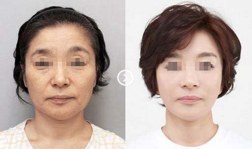 深圳激光除皺價(jià)格多少錢？能?徹底的去除嗎?