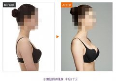 假體隆胸價(jià)格是多少？