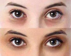 愛美女生如何消除黑眼圈？