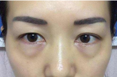 如何消除眼袋才有效？