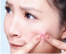 滿臉痘印怎么辦？