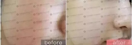 水光后為什么皮膚反而會變黑？