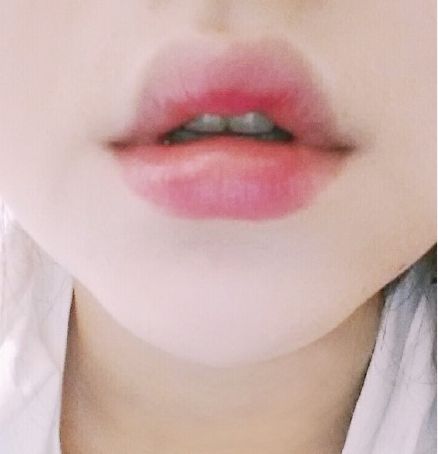 用玻尿酸豐唇后怎么護(hù)理？