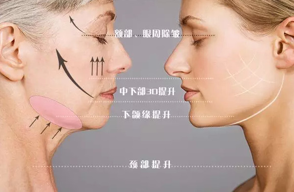 天津臉部做埋線提升后遺癥有什么？