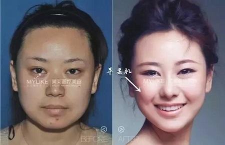 這四種臉型打玻尿酸+瘦臉，立刻變專業(yè)小V臉