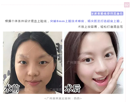 腫眼泡？重內(nèi)眥？