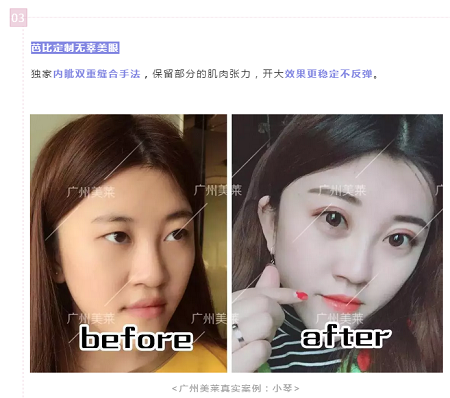 腫眼泡？重內(nèi)眥？