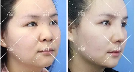 想隆鼻又不想用自己的軟骨，急需一個(gè)男票！