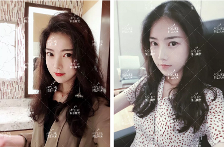 玻尿酸拯救失去的少女感?。?！你也能和娜比一樣美！