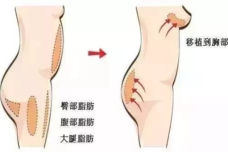 自體脂肪隆胸 vs 假體隆胸，該怎么選？哪個更好更安全？