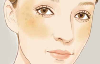 廣州美萊醫(yī)療美容醫(yī)院祛斑效果好嗎？