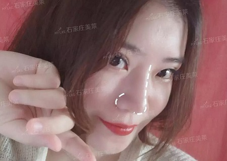 “扁塌鼻”都是潛力股，做完鼻整形，顏值逆風翻盤！