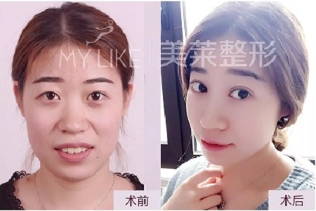 這幾種眼睛割完雙眼皮超美！不信，看她們的術(shù)后效果~