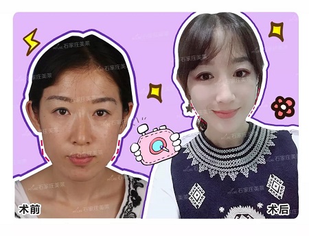 方臉妹紙做完下頜角，看上去減齡5歲！