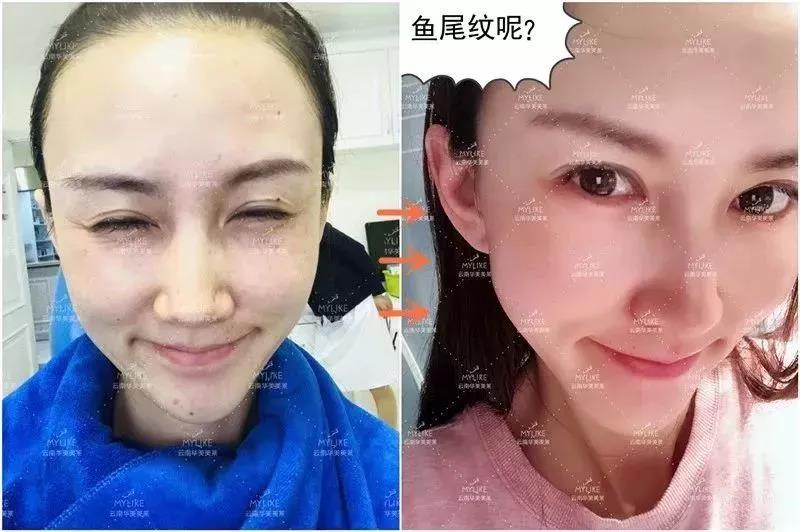 玻尿酸瘦臉打夠次數(shù)就能瘦下來(lái)，除皺打夠次數(shù)也能一直保持嗎？
