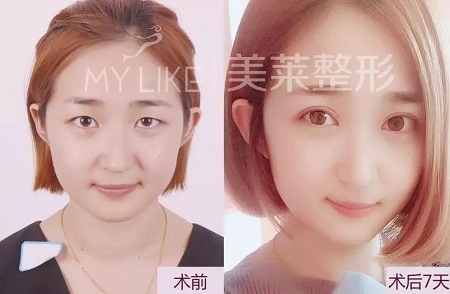 美萊特邀“美眼女神”畢小麗，3月13日親診石家莊美萊。