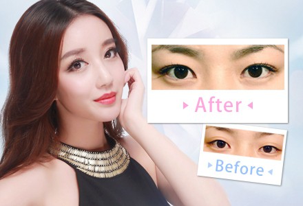 做個(gè)雙眼皮的價(jià)格要多少錢(qián)？
