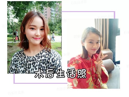 我近視做雙眼皮，對(duì)眼睛有影響嗎？圍觀小姐姐術(shù)后反饋！