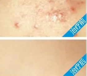 白瓷娃娃治療