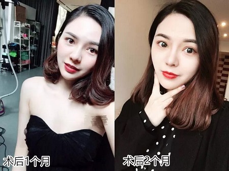 她只是做了鼻子整形，立馬變上鏡殺手！