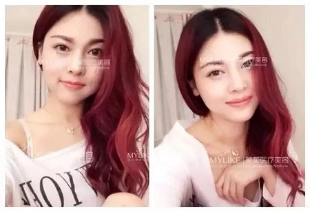為什么打了玻尿酸，還要我再打玻尿酸？