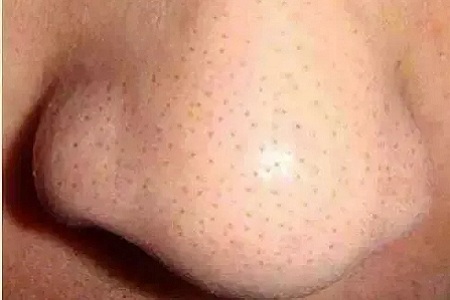 你知道臉上的黑頭和白頭是怎么形成的嗎？