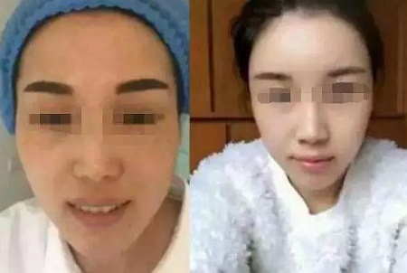 自體脂肪活顏精*，讓你年輕20歲
