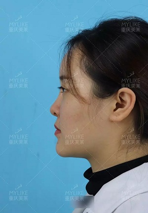 “鼻綜合”后假又歪，還攣縮？鼻修復(fù)還原自然生態(tài)美鼻