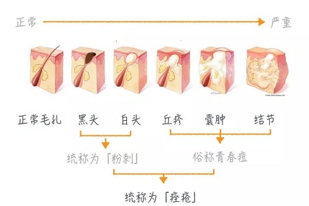擠痘竟然被送進ICU！你的痘痘還好嗎？